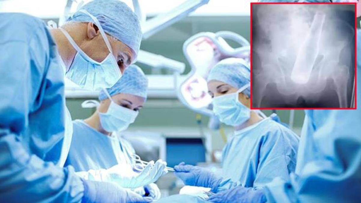 Acı içinde hastaneye giden yaşlı adamın makatından bira şişesi çıktı! Nedeni olay kadar ilginç