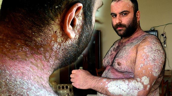 Sedef hastalığı nedeniyle vücudu pullanan Murat, sağlığına kavuştu!