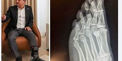 CHP Genel Başkanı Özgür Özel Ayak rötgenini cevap olarak paylaştı